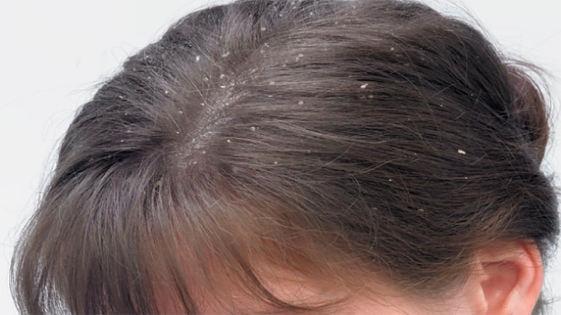 Ngoài công dụng chính là trị gàu, dầu gọi Selsun còn giúp cân bằng môi trường da đầu, ngăn gàu tái phát