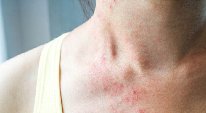 Cách điều trị khi bị bệnh viêm da dị ứng Dấu hiệu của viêm da dị ứng