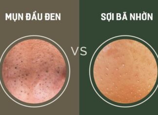 Cách xử lý sợi bã nhờn và mụn đầu đen trên mũi hiệu quả