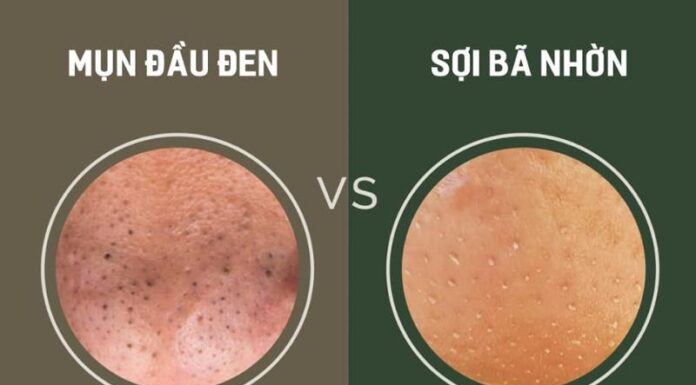 Cách xử lý sợi bã nhờn và mụn đầu đen trên mũi hiệu quả