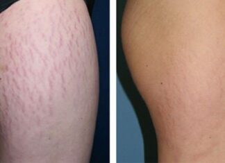 Mách nhỏ bạn cách trị rạn da tại nhà an toàn, tiết kiệm mà lại hiệu quả