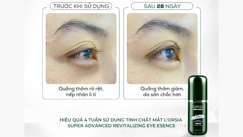 Hiệu quả sau 4 tuần dùng Tinh chất mắt Lorsia Advanced Super Revitalizing Eye Essence